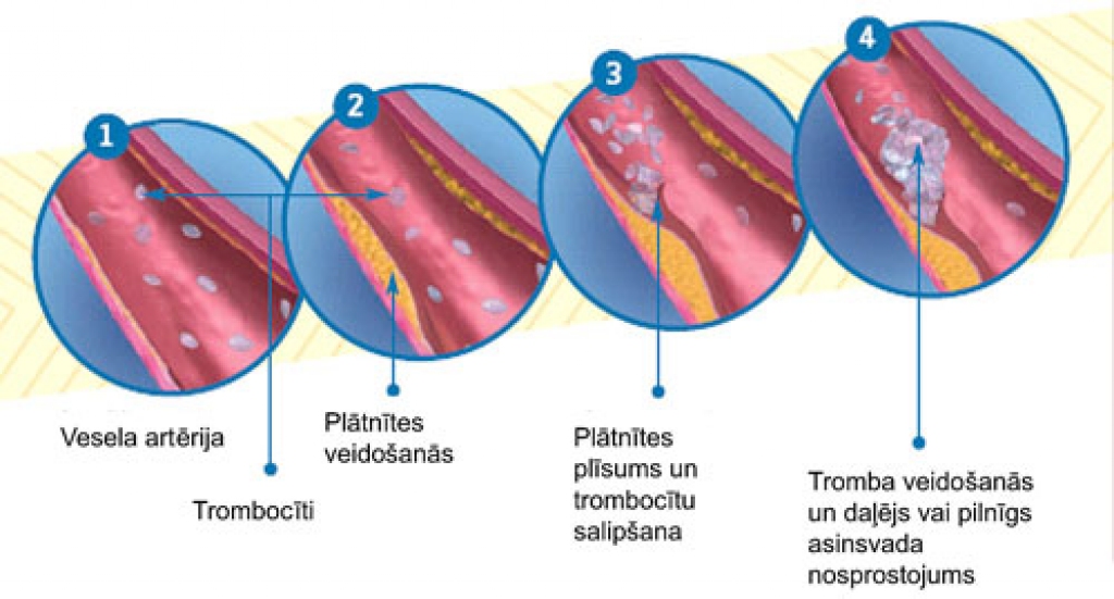 Ja holesterīna asinīs ir pārāk daudz, tas izgulsnējas uz asinsvadu sieniņām, veido sabiezējumus, kas traucē asinsritei. Tas var būt insulta un infarkta risks.