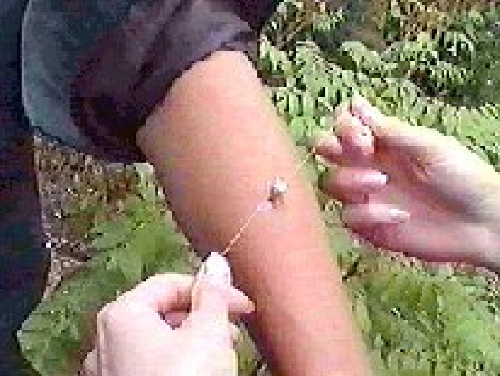 Lai izsargātos no saslimšanas ir ļoti svarīgi, lai ērci pareizi noņemtu.
Autors: no www. homes.dpunet.lv