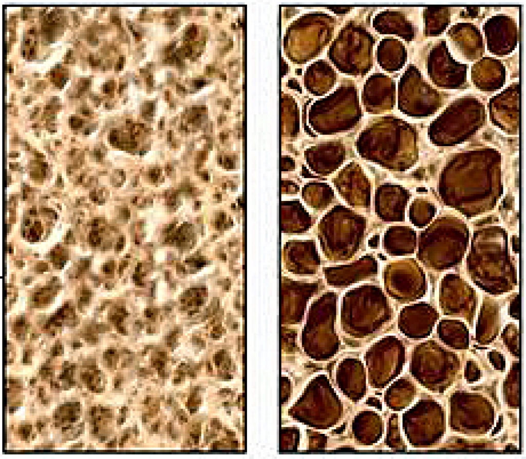 Normāls kaulu blīvums (pa kreisi) un osteoporozes skarti kauli.
Autors: www.vc4.lv