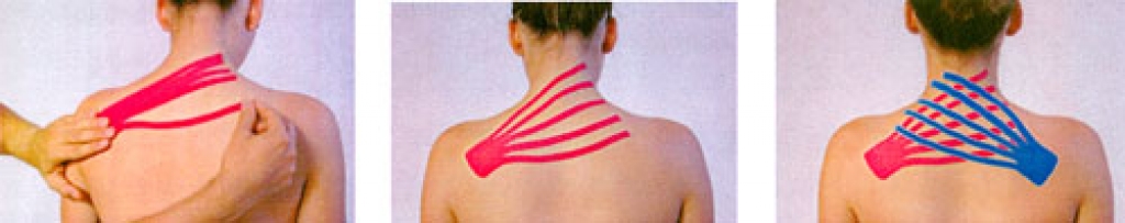 Kakla un apkakles sāpju mazināšana ar teipošanu: pirmo saiti pielīmē vēdekļa veidā, iestiepjot to par 10 – 20 procentiem, otro saiti no pretējās puses uzlīmē līdzīgi.